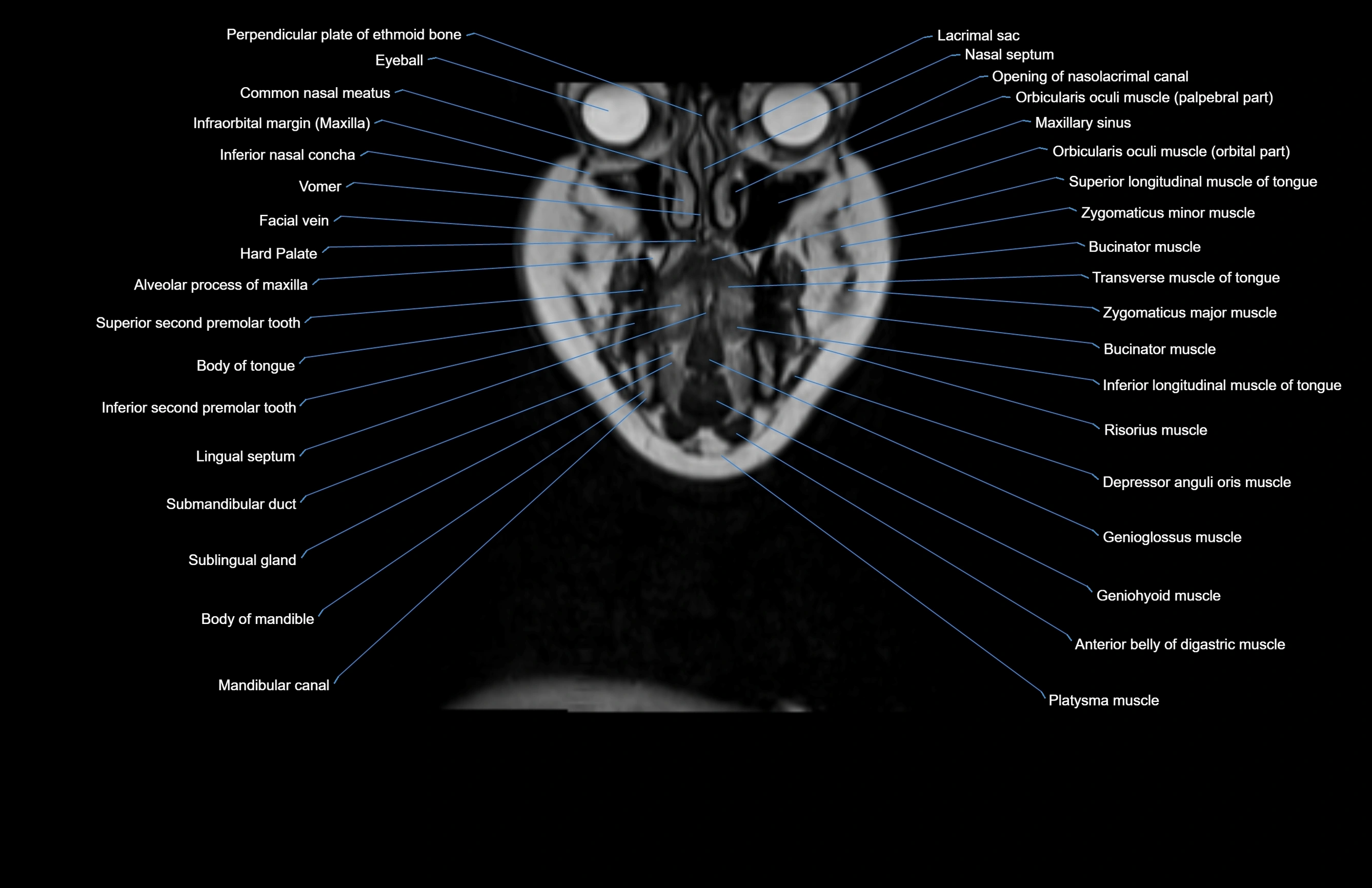 Neck coronal cross sectional MRI anatomy 3T MRI  image-img-00001-00067.webp